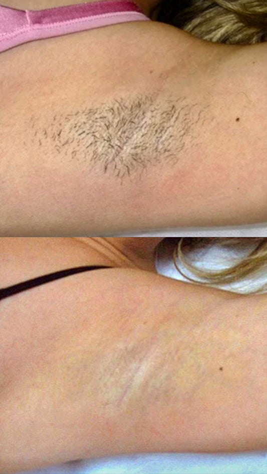 Pain Free Permanent Laser Hair Removal